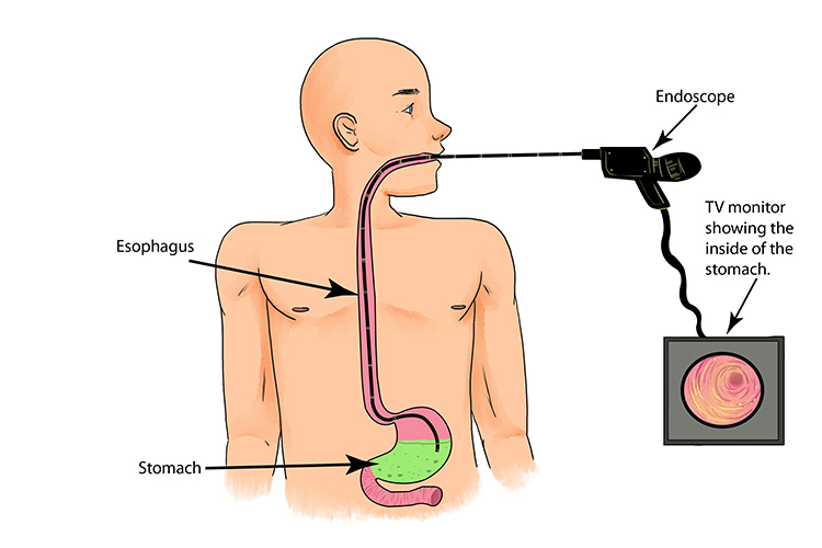 The optical fibre of an endoscope is passed down through the oesophagus to see inside the patients stomach.